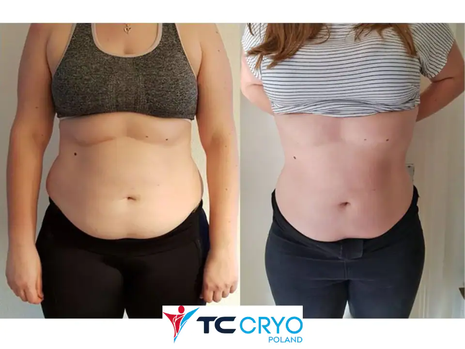 TC-Cryo-efekt-BTMED-7-2