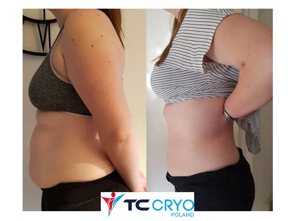 TC-Cryo-efekt-BTMED-8-2