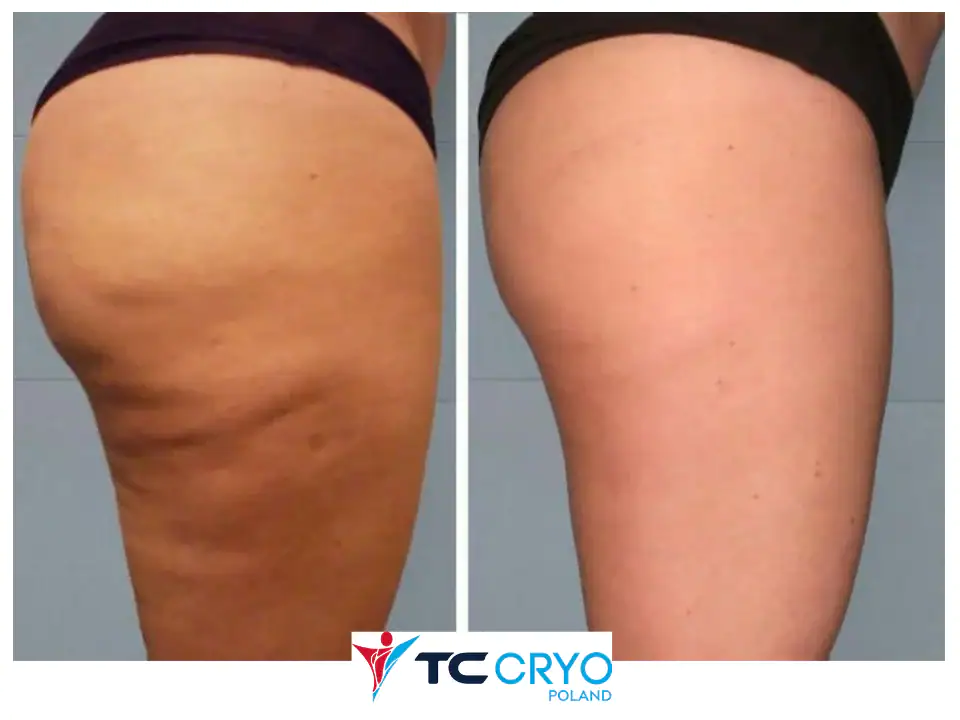 TC-Cryo-efekt-BTMED-9